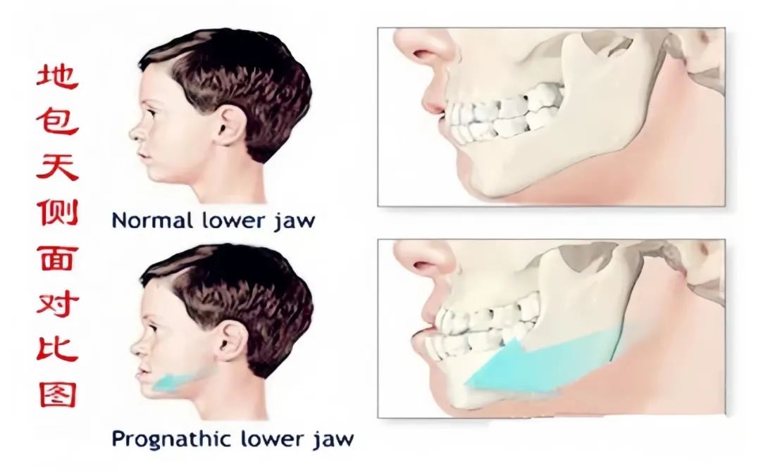 对齿和地包天的区别图片