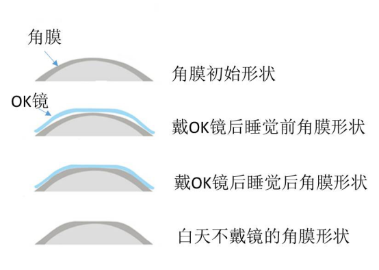 五一假期出游，合肥普瑞视光专家告诉你：OK镜要怎么办？