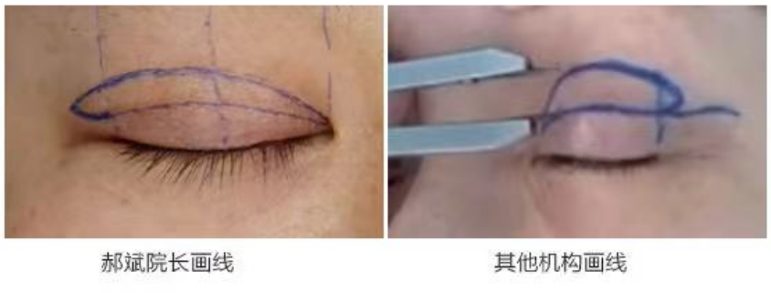 北京煤医郝斌院长:即塑媚眼术,精细化缝合下的无痕效果